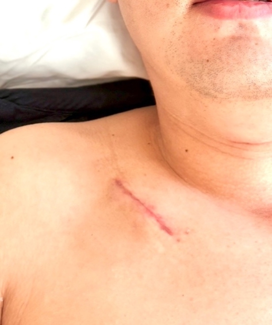 術后皮下脈沖發射器植入位置的微創切口。